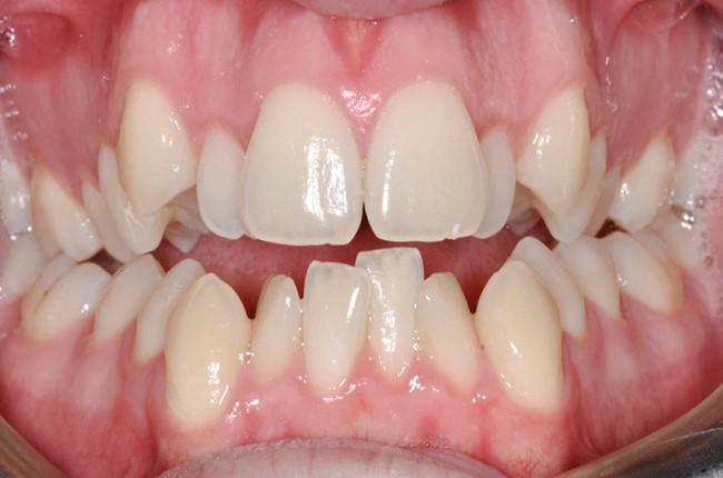 Api�amiento dental: �c�mo tratarlo? - Foto
