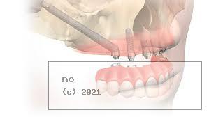 Falta de hueso para colocar un implante dental: soluciones - Foto
