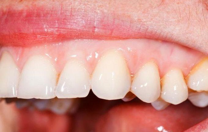 Enc�as blancas: �cu�les son sus causas? - Foto