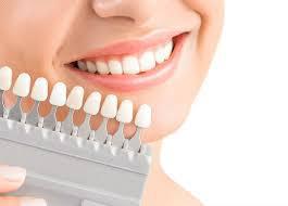 �En qu� casos las carillas dentales son recomendables para mejorar la sonrisa? - Foto