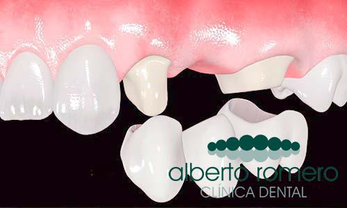 Implantes dentales o puentes dentales: �cu�l es la mejor opci�n? - Foto