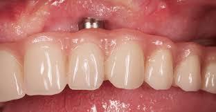 �Por qu� fracasa un tratamiento de implantes dentales?  - Foto