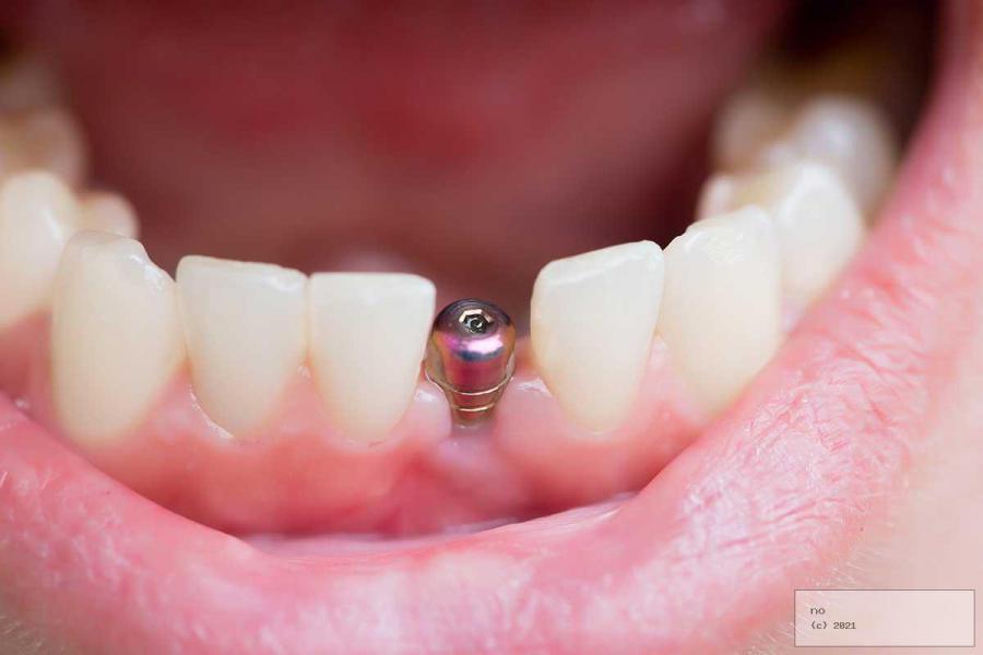 Implantes dentales: factores que aumentan el riesgo de rechazo. - Foto