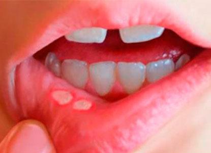 �Qu� es la estomatitis? - Foto