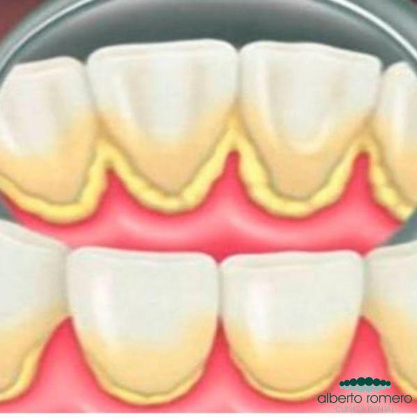 Diferencias entre placa bacteriana y sarro dental - Foto