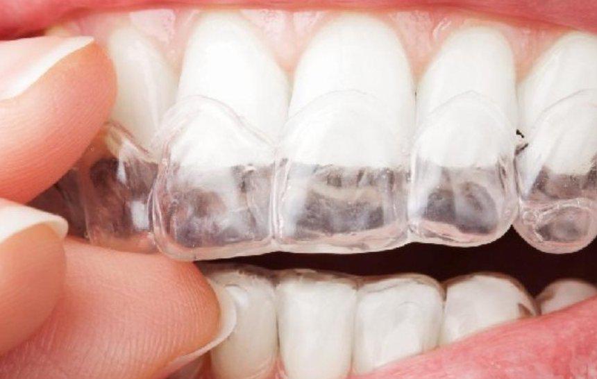 Solo un dentista puede indicar el uso de f�rulas de descarga - Foto