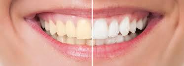 Dientes amarillos: causas y tratamiento - Foto