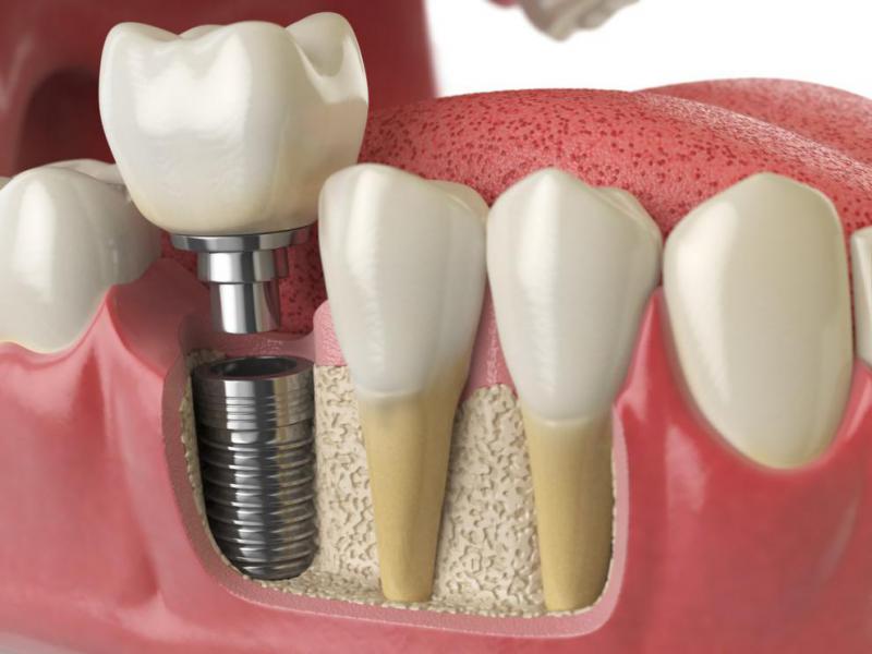 Recuperaci�n tras la colocaci�n de implantes dentales - Foto