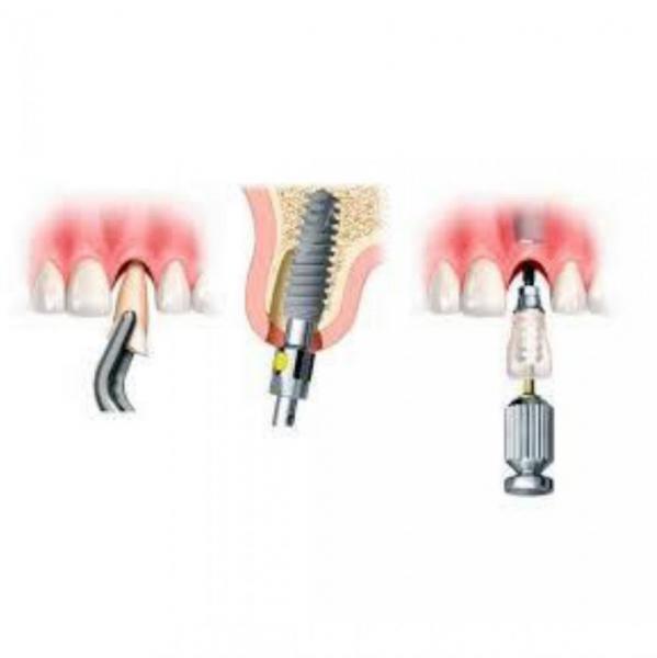 Implantes dentales de carga inmediata: �mejores que otros tratamientos? - Foto