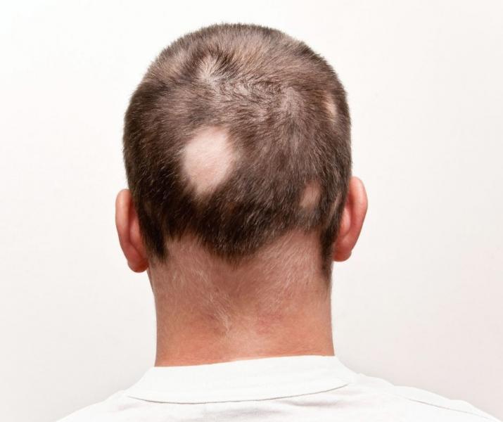 Alopecia areata, s�ntoma de infecci�n bucodental - Foto